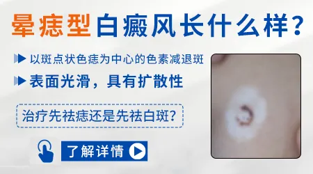 晕痣型白癜风复发的概率高不高