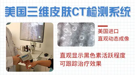 皮肤ct检查对治疗白癜风有帮助吗