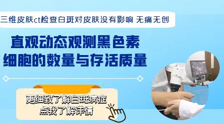 皮肤CT检查对白斑的误诊率大概是多少