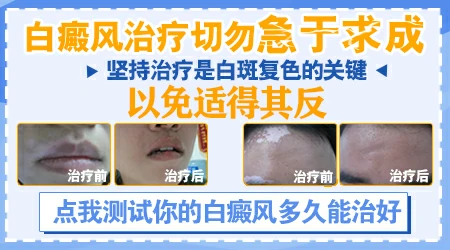 白癜风这个真的能治好吗