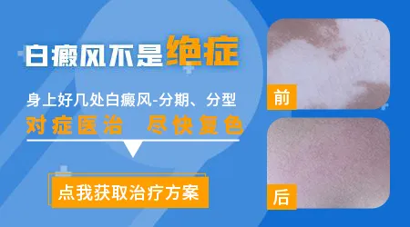 白癜风初期是什么样子的