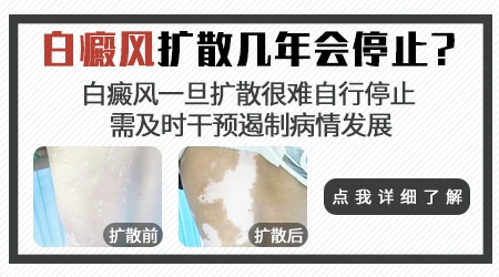 白癜风发展期一般会持续几个月