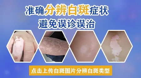 白癜风早期和其他白斑有什么区别图片对比