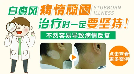 白癜风照311光和308光的区别是什么