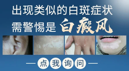 皮肤上长了块比周围白的斑要紧吗