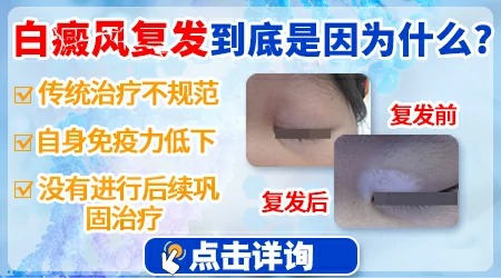 目前白癜风能不能根治