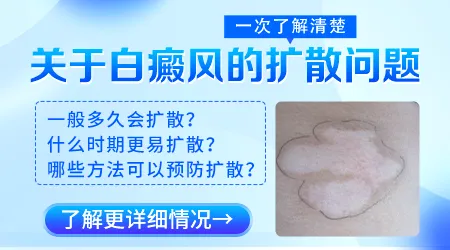 白癜风初期图片有哪些特殊表现
