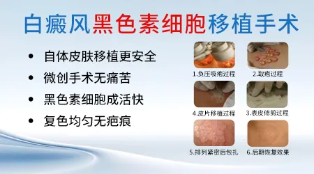儿童臀部和腿部大片白癜风照激光好还是做植皮手术好