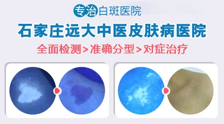 花斑癣和白癜风如何鉴别