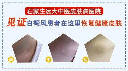 石家庄远大中医皮肤病医院口碑怎么样