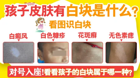 小孩脸上出现白斑是肚子里有虫吗