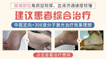 肢端型白癜风中医治疗效果好吗
