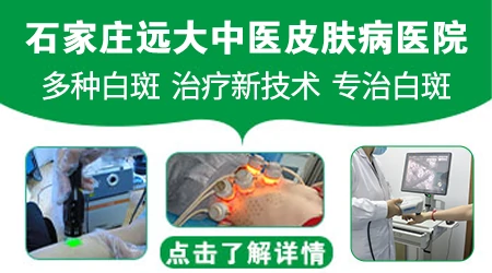 白癜风去石家庄哪个医院治