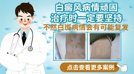 头皮上长白斑头发也变白了是什么问题
