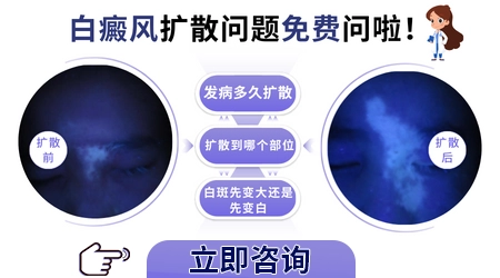 白癜风扩散前会有什么征兆