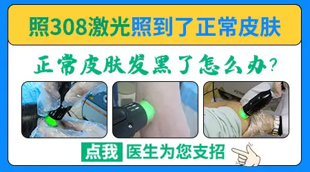 白癜风照光后正常皮肤被照黑了能恢复吗