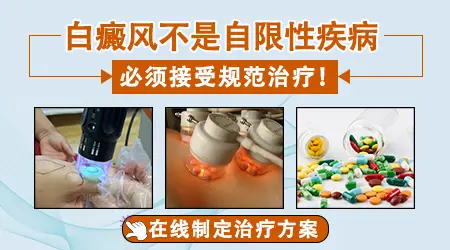 白癜风初期不治疗会自己好吗
