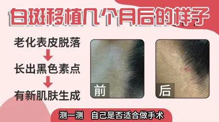 皮肤移植手术适合所有色素减退患者吗