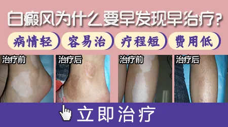 白癜风开始有什么征兆图片