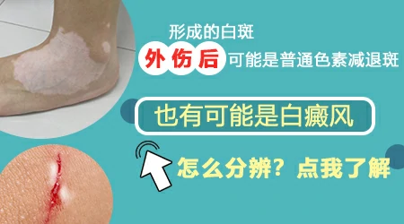 外伤后长出白斑是白癜风吗