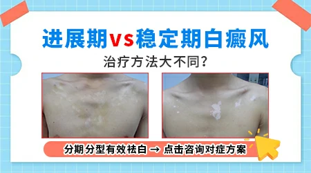 白癜风用什么药见效快效果好