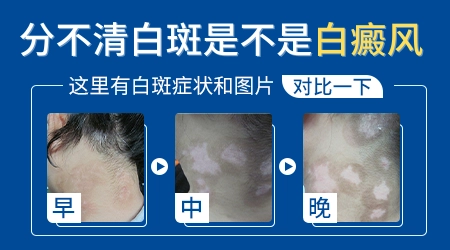 不同种类白斑早期什么症状怎么区分
