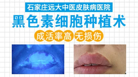 黑色素种植治疗白癜风好吗