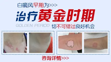 白癜风早期有什么症状图片参考