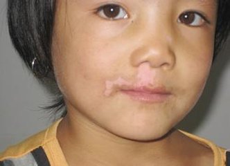 小孩子的白癜风疾病有哪些特征