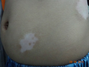 肚皮上有白斑图片 小孩长白斑的原因