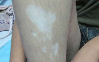 白斑是白癜风吗 小孩腿部有块比正常皮肤白 