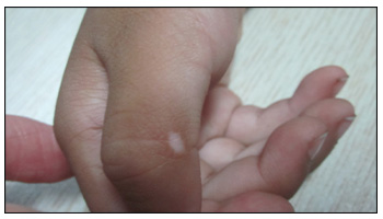 小孩手指关节长了个白色小米粒大的白斑
