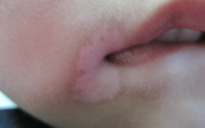 儿童嘴唇边不清晰的白斑是不是白癜风