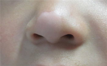 鼻梁上有块皮肤变白白的什么情况