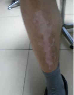 肢端型白斑病的症状表现