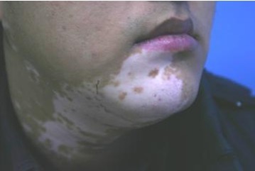 幼儿白斑应该怎么样治疗好