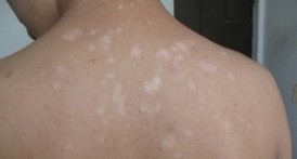 白斑扩散有可能是哪种皮肤病