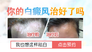 口周白癜风很明显怎么治 能治好吗
