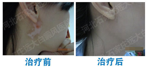 耳后白癜风治疗效果图片 白斑治疗一次多少钱