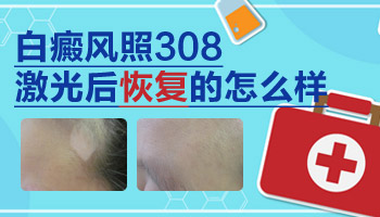 308治疗白癜风多久可以恢复正常皮肤