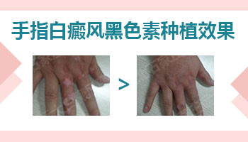 手指白癜风植皮手术恢复图片