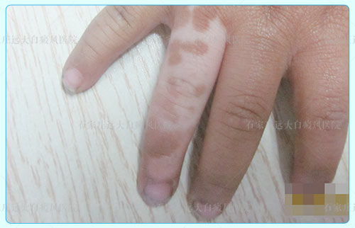 手指关节白色斑会不会扩散 白癜风能治好吗