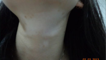 脖子的白斑已经很多年了能治好吗