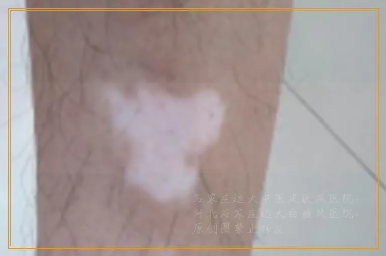 308激光照白癜风皮肤会出现什么症状