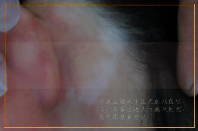 稳定期还会不会出现新的白斑