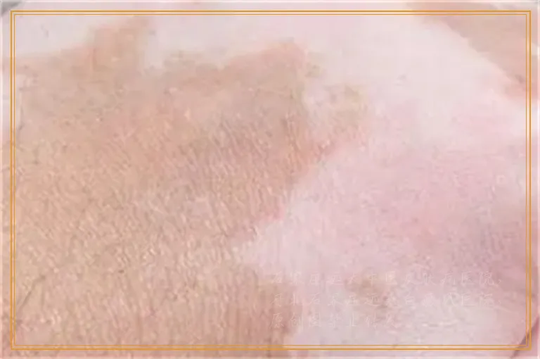 后背上有一块皮肤变白是怎么回事