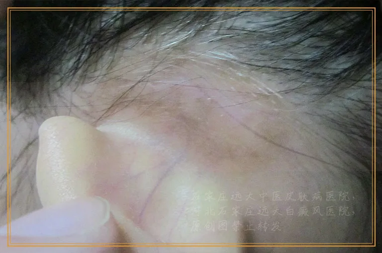 3岁孩子身上白一块会不会是长了白癜风