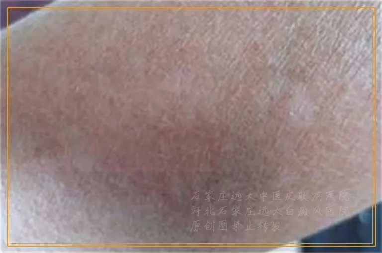 宝宝2岁不到脸上有一块白斑怎么治