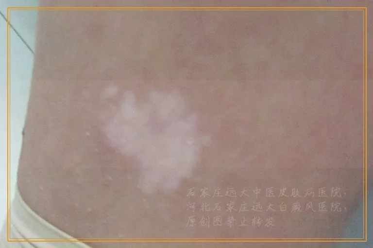 12岁男孩背上有一块皮肤发白怎么回事