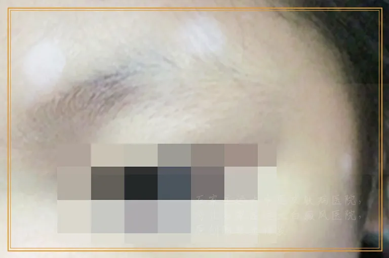 腿两边出现一片一片白的这什么病